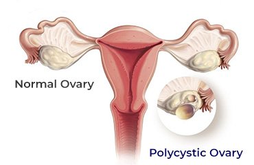 Understanding the Difference Between PCOS and PCOD? Its Causes, Symptoms, and Treatment