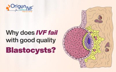 Why Does IVF Fail With Good Quality Blastocysts