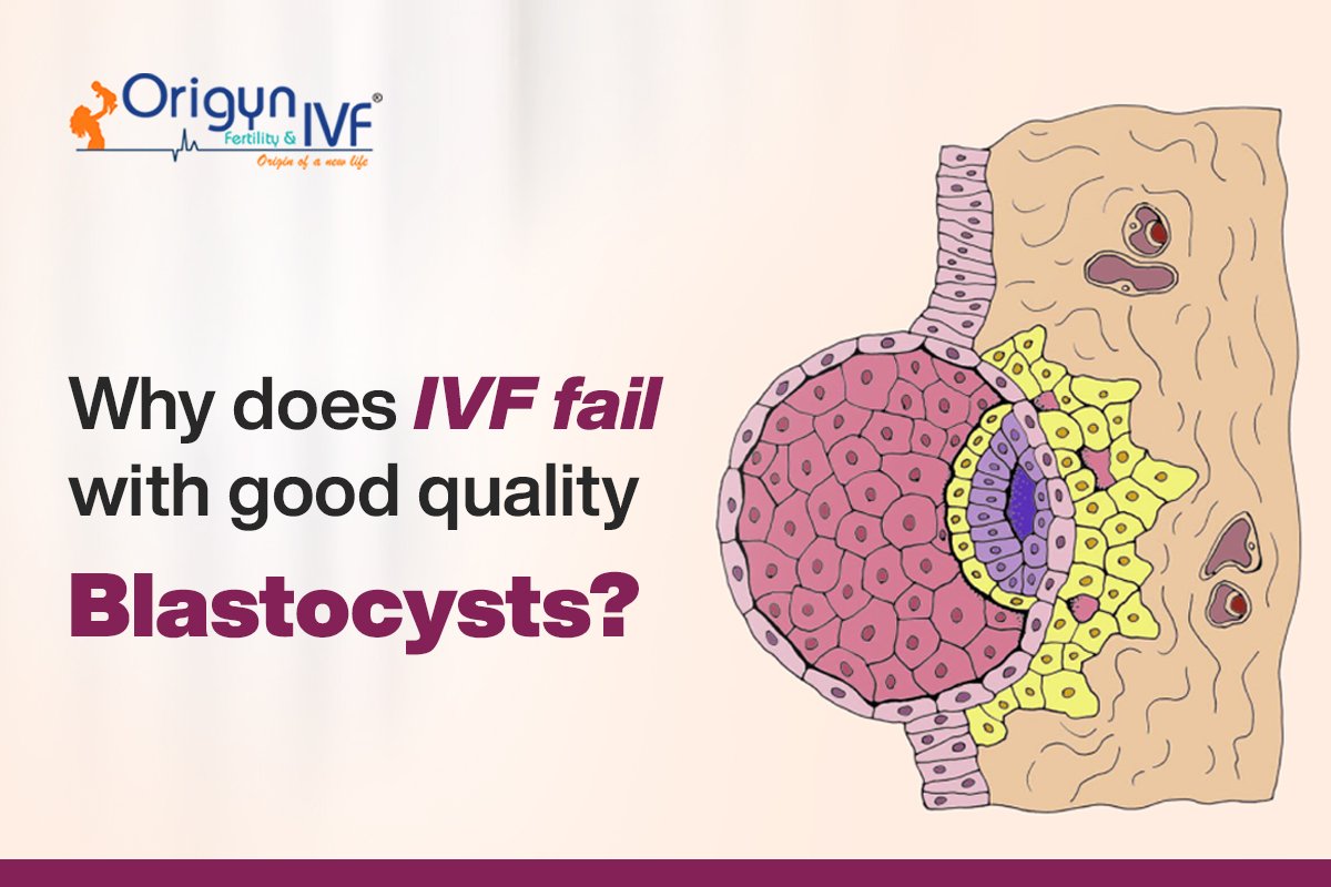 Why Does IVF Fail With Good Quality Blastocysts?